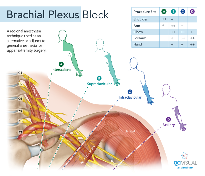 Anterior view of brachial plexus and surrounding tissue and muscles. Lines indicate levels of brachial plexus blocks and arm areas affected.