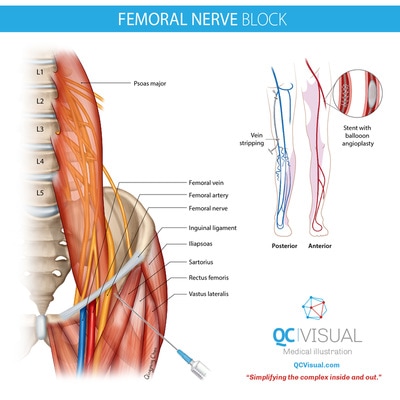 Anterior view of lower abdominal and upper leg anatomy showing anatomical landmakrs for a femoral nerve block. 
