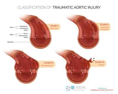 Four classifications of aortic injury, shown in cross-sectional view