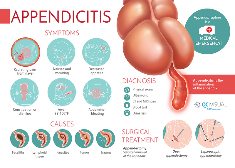 TheInfographic of appendicitis showing symptoms, causes, diagnosis and surgical treatment.