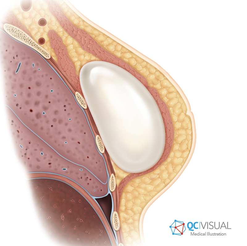 Sagittal cross-section of female breast anatomy with silicone breast implant.
