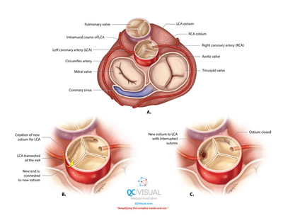 Superior view of human heart showing mitral and tricuspid valves, pulmonary trunk and aorta. Before and after of intramural LCA surgery on aorta.