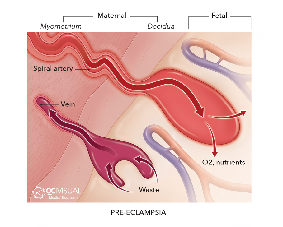 Maternal and fetal blood vessels showing direciton of waste, nutrient and oxygen exchange across the placenta in pre-clampsia
