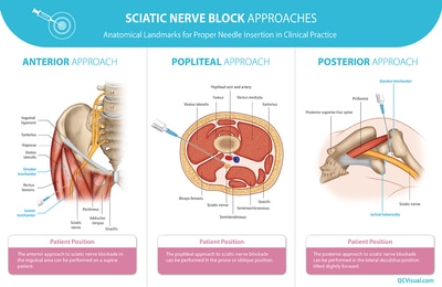 Three approaches to sciatic nerve blocks, showing anterior thigh anatomy, popliteal horizontal cross-section and posterior landmarks. 