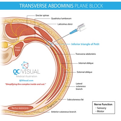 Horizontal cross-section of abdominal wall at the lumbar level showing location of transverse abdominis plane block. 
