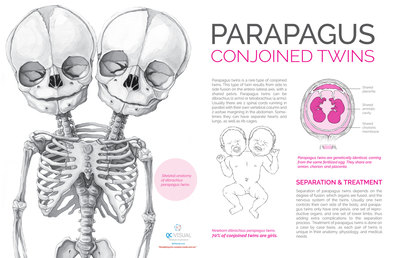 Parapagus conjoined twins as a skeleton, full-term baby and in-utero fetus